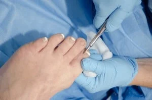 ingrown toenail treatment in Pittsburgh 