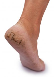heel corn and callous treatment