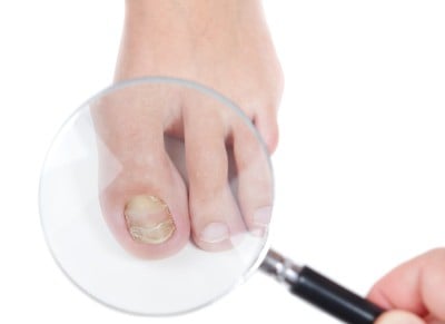 toenail fungus treatment Pittsburgh 