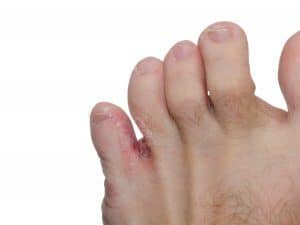 Treatment for painful corns best sale between toes