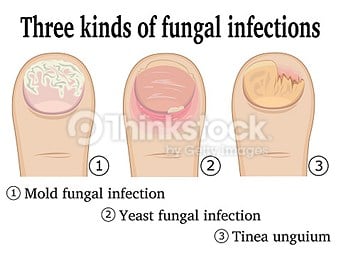 Onychomycosis (Tinea unguium, Nail fungal infection) - Infectious