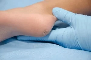 Warts treatment pittsburgh 