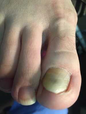 Involuted Toenails - The Foot People