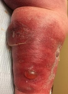 Blood blister on on sale bottom of foot