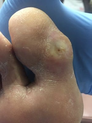 Foot Calluses: Prevention and Treatment Tips - Feet First Clinic