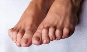 What is a Hammer Toe?  What is the Main Cause of Hammer Toes