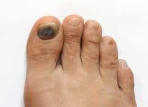 Blood Blister center twp foot