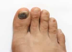 Runner's toe Subungual hematoma ), repetitive injury toes seen in runners - Beaver Valley