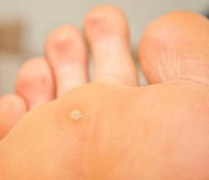 plantar warts