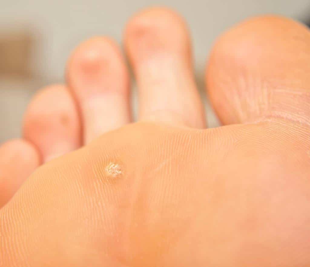 Plantar Wart Treatment With Lasers for Wart Removal BVFC