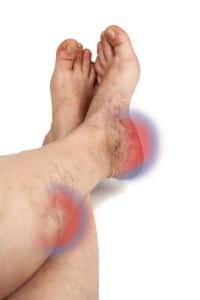 Blood Clot In Foot Symptoms Treatment Bv Foot Clinic