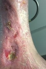 leg ulcer