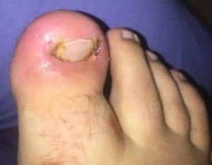 ingrown toenail