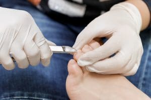 ingrown toenail treatment