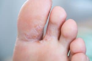 5 Natural Eczema on Feet Treatments