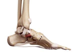 Heel Pain