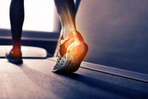 Plantar Fasciitis