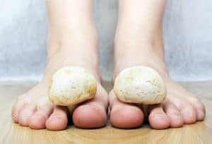 Toenail fungus treatment