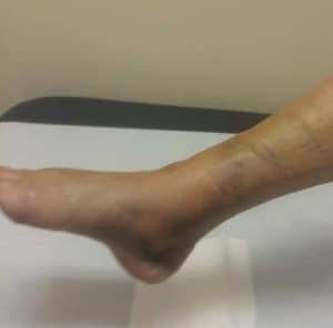 Foot and Ankle Surgery - Beaver Valley Foot Clinic