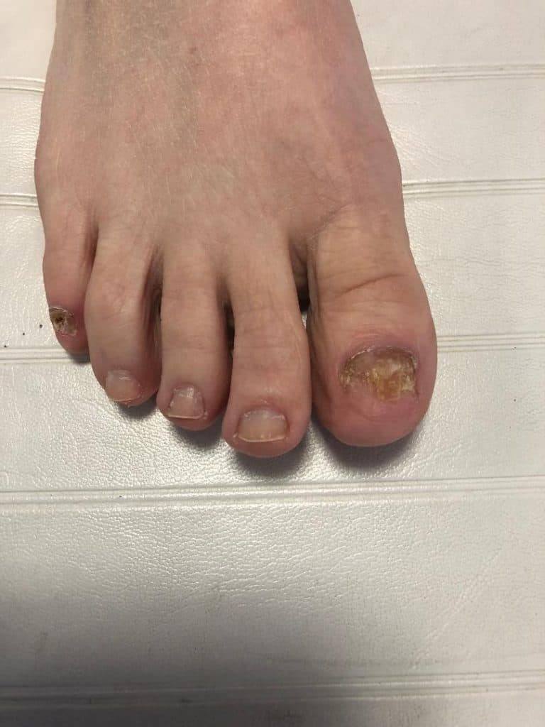 How You Can Stop Foot and Toenail Fungus In Its Tracks