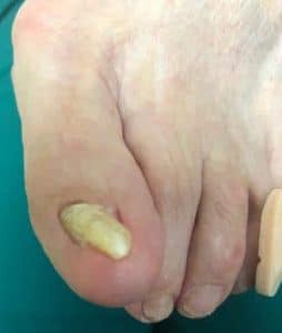 Fungus Toenail infection