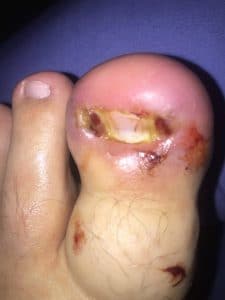 cellulitis foot