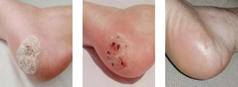 Blood blister on bottom of outlet foot