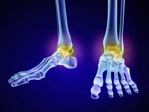 Ankle fracture: diagnosis and therapy