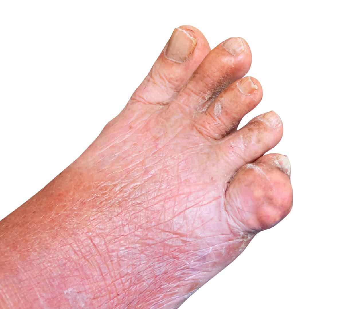 gout bottom of foot