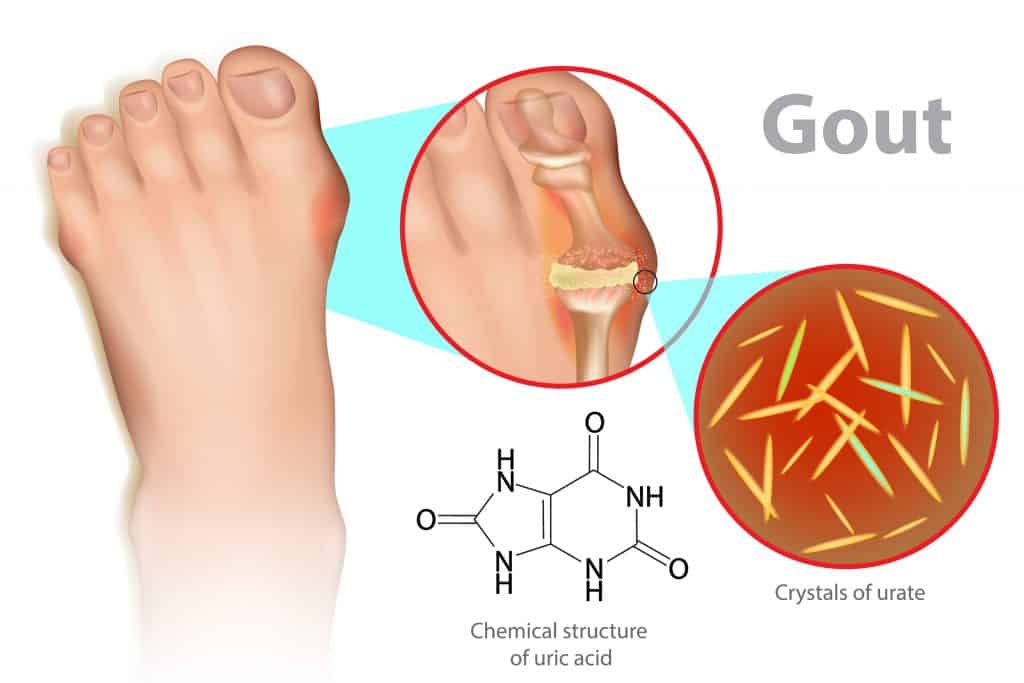 Podiatrist for Gout Treatment and Symptoms Near Me Beaver Valley Foot Clinic (2022)