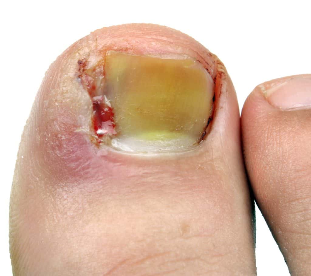 Is your big toe stiff and sore? Symptoms and treatment