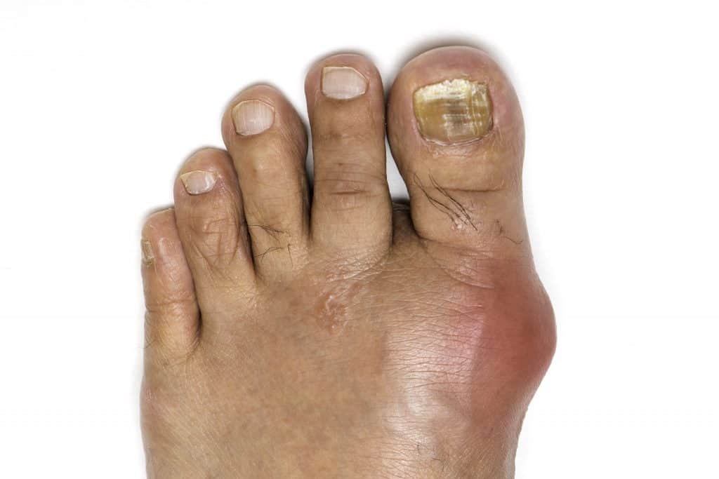 Swollen Big Toe (Hallux Edema)