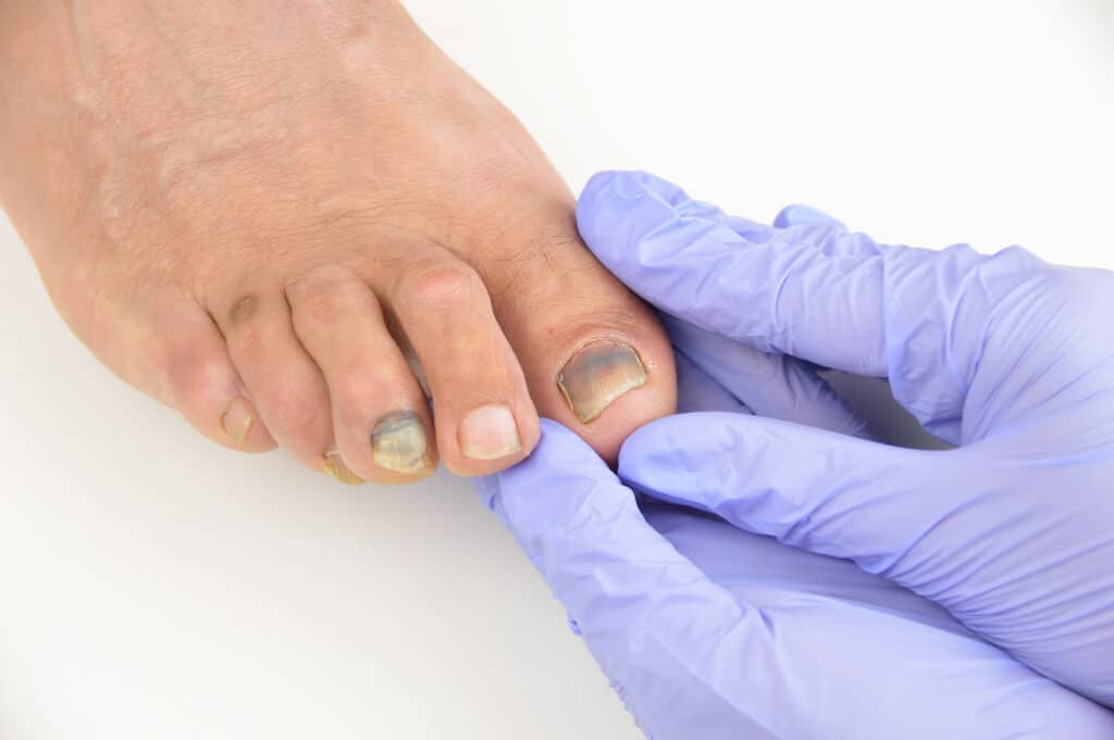 What are the Symptoms of Ingrown Toenail & their Treatment by Podiatry  Centers - Issuu