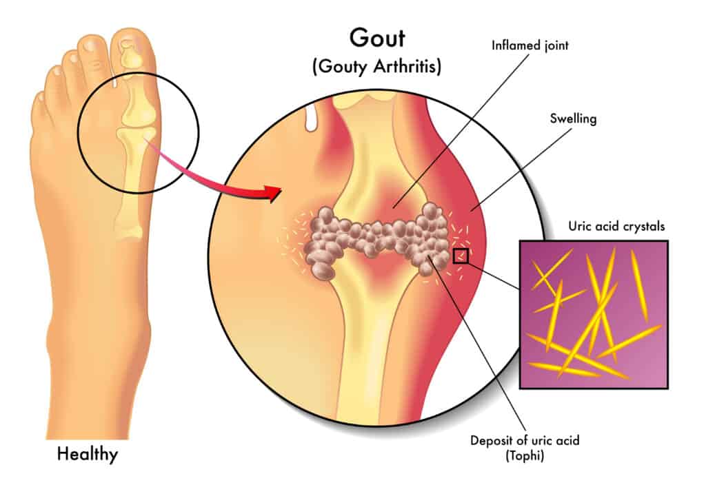 does biofreeze work for gout