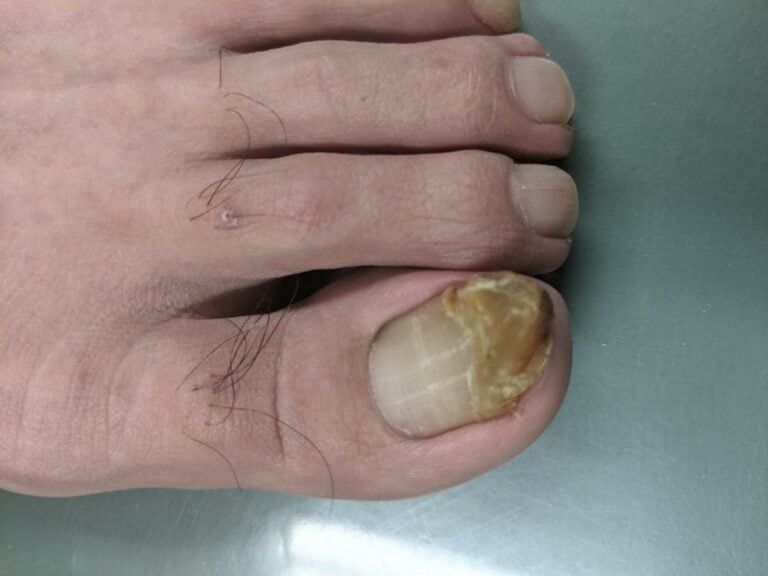 Toenail Fungus Treatment Laser Beaver Valley Foot Clinic