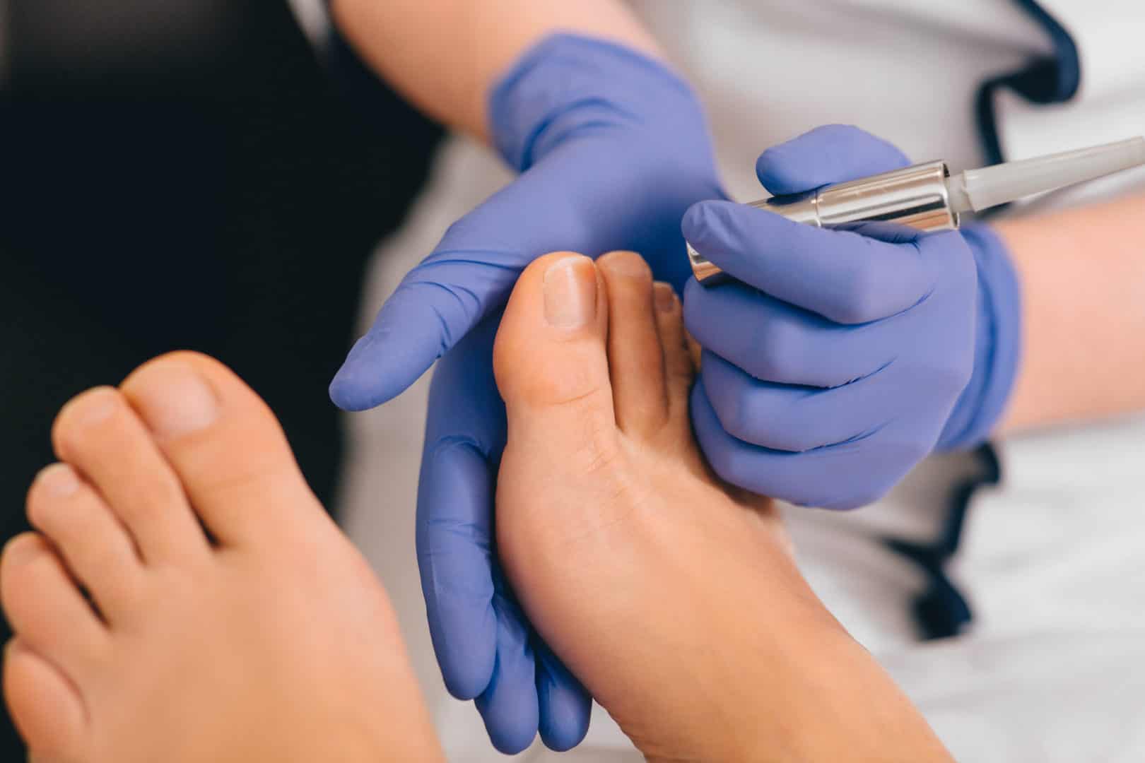 Matrixectomy: When a Permanent Toenail Removal Is Necessary