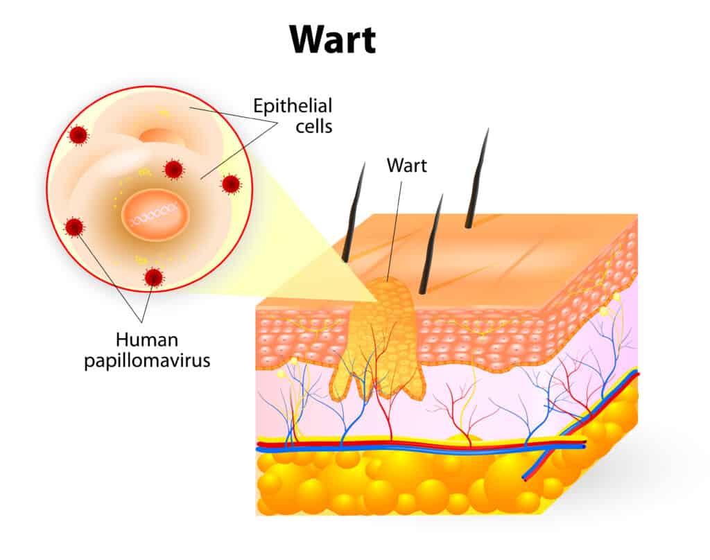 wart image