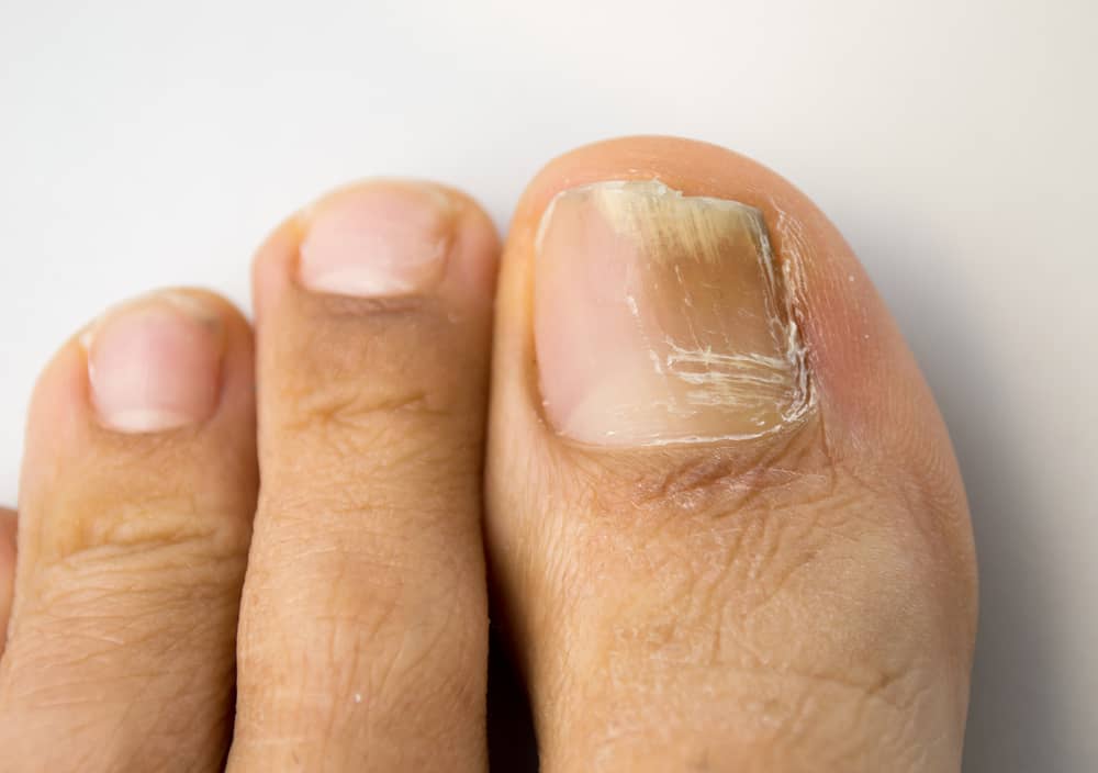 Fungal Infection In Nails - 11 Ways It Can Be Managed! - By Dr. Niraj  Goenka | Lybrate